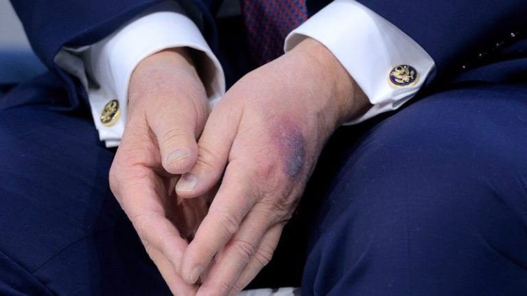 White House explains bruise on Trump’s hand